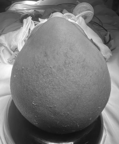 Metopic synostosis - Triangle shaped head