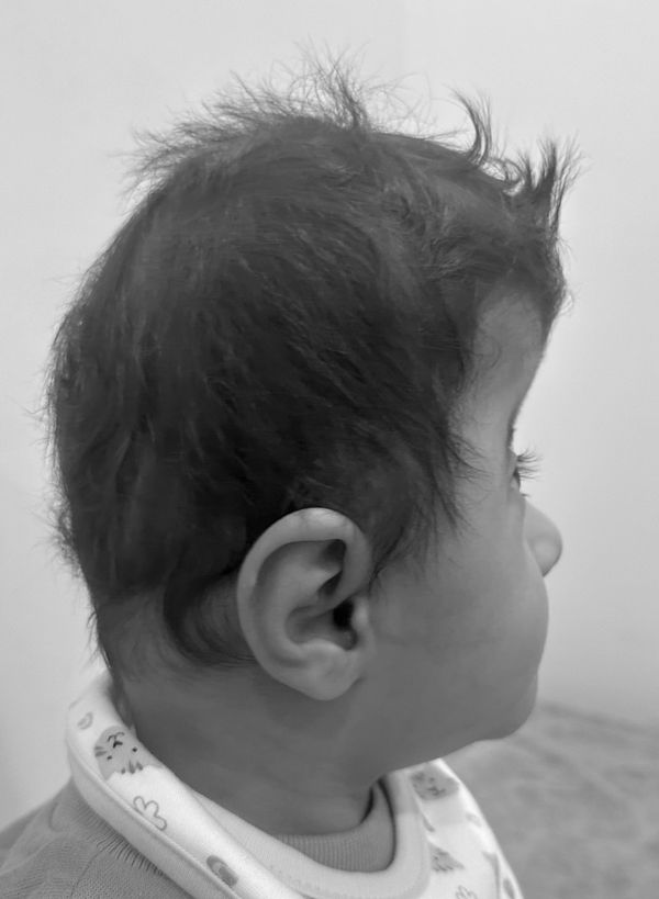 Apert syndrome