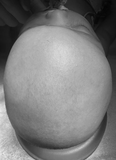Unicoronal synostosis - Twisted head