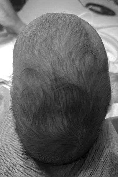 Sagittal synostosis - Long narrow head