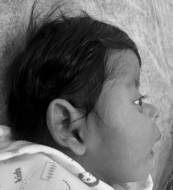 Crouzon syndrome