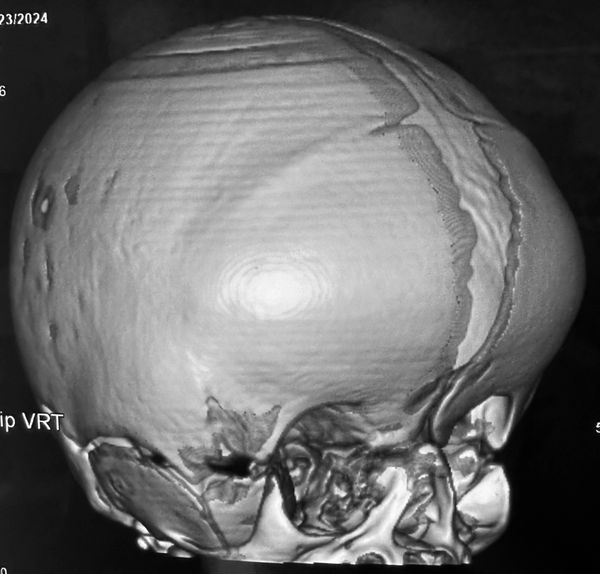 Saethre Chotzen syndrome