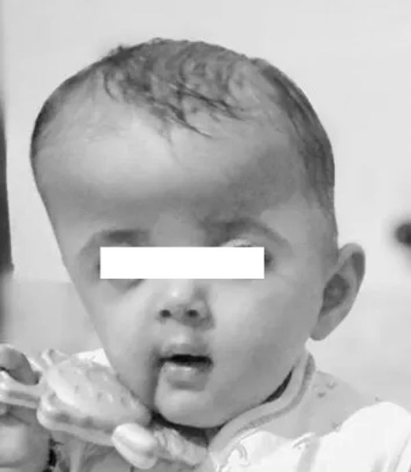Muenke syndrome