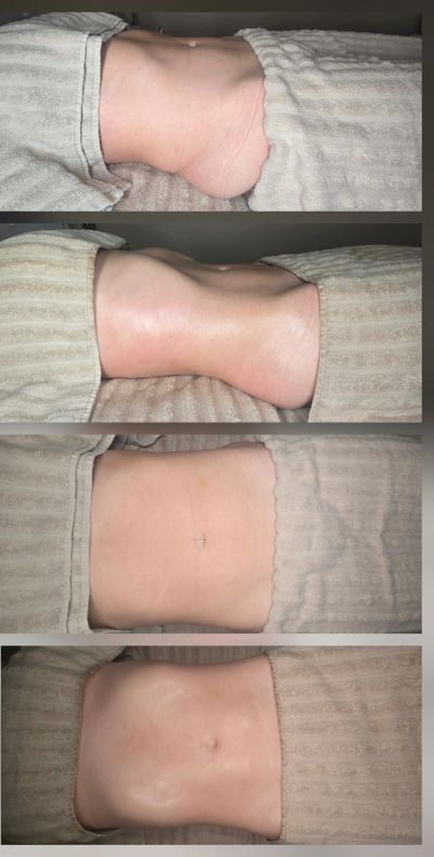 Four images showing gradual abdominal slimming and contouring results.
