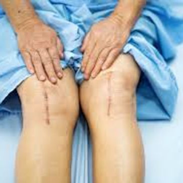 Post-surgical knees with visible scars and hands on them.