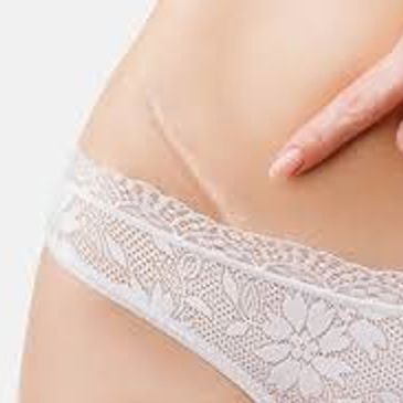 Close-up of a scar on a woman's lower abdomen above white lace underwear.