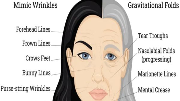 Types of face wrinkles, facial fine lines, Mental creases above chin, Nasolabial folds smile lines