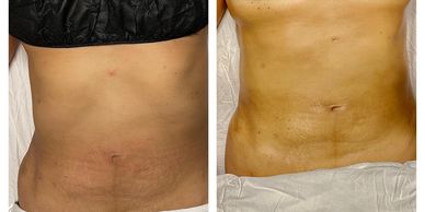 MLD session for post liposuction. 2 weeks old.