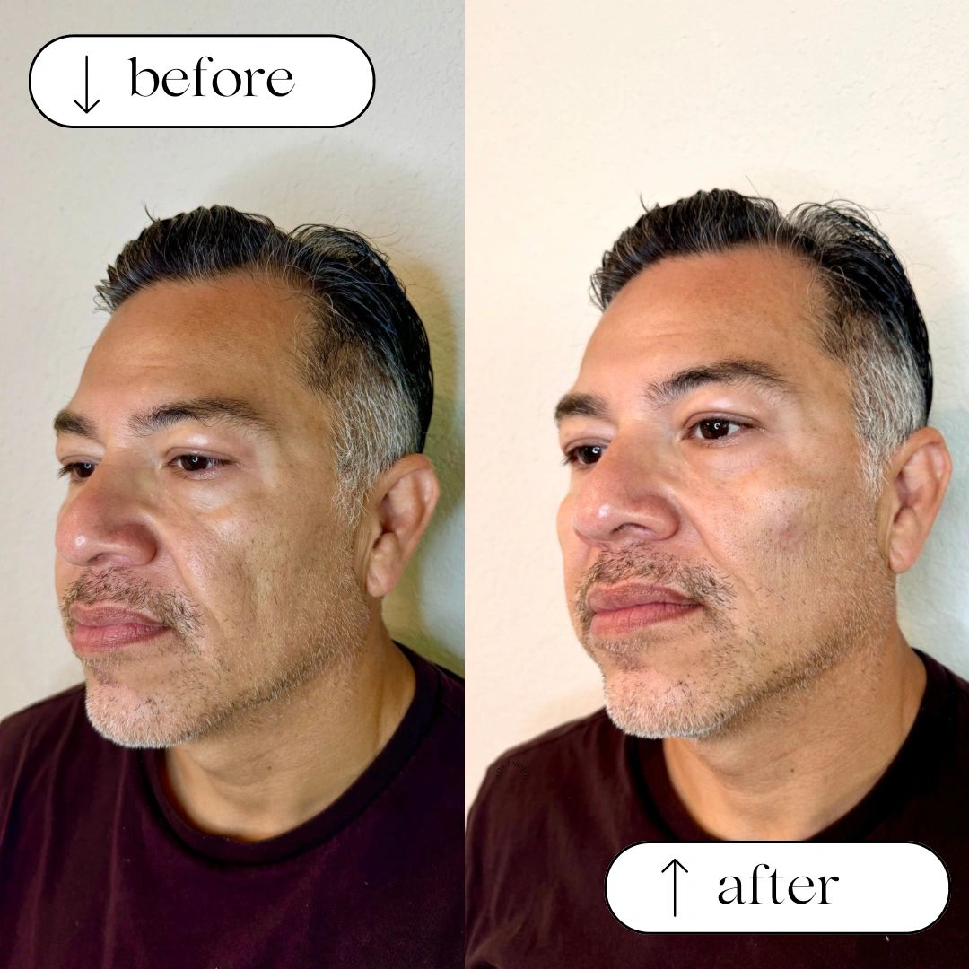 Side-by-side before and after photos of a man's face showing skin improvement.