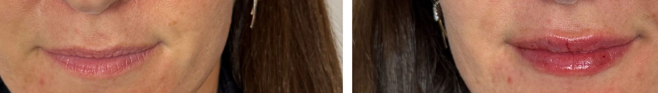 Before and after lip enhancement showing fuller lips with slight redness after procedure.