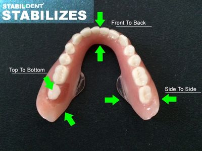 We invented Stabil-Dent lower denture stabilizers.  Every lower denture benefits from Stabil-Dent.