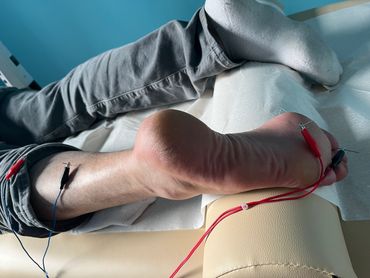 Acupuncture treatment for plantar fasciitis.