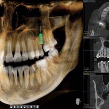 3D cone beam and implants