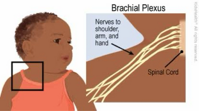 Illustration of brachial plexus nerves in a child's shoulder and arm.