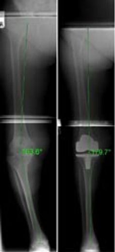 An X Ray showing perfect alignment after Knee replacement surgery. Deformity has been corrected