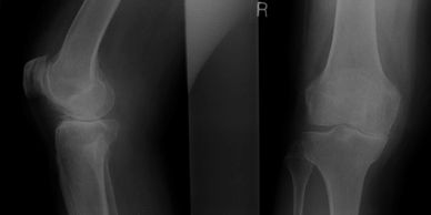X-Rays showing severe end stage osteoarthritis of the knee joint