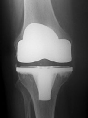 X Rays of a TKR - Total Knee replacement prosthesis after knee replacement surgery