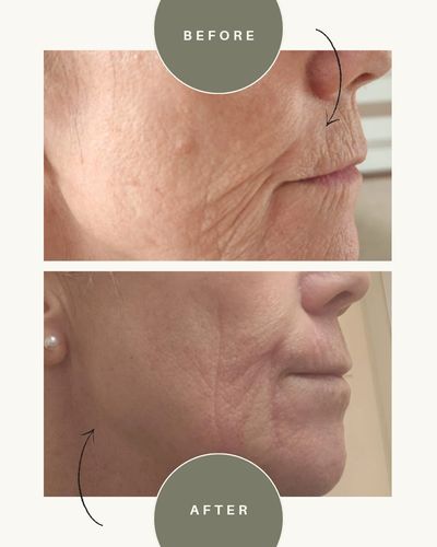 Before and after client photo of plasma fibroblast