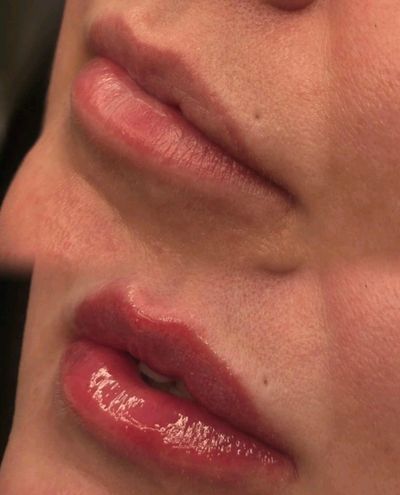One of my clients before and after dermal lip filler placement 