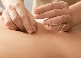 Acupuncture treatment with needles.