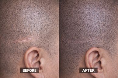 SMP Scar Coverage