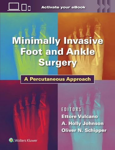 Minimally Invasive Foot and Ankle Surgery: A Percutaneous Approach First Edition. Vulcano, et al.