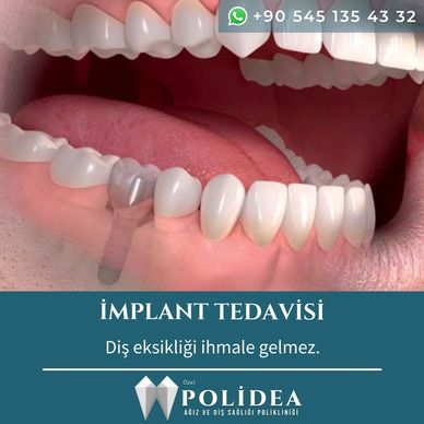 Polidea İmplant tedavisi implant üstü protez cerrahi 