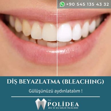Polidea diş beyazlatma bleaching beyaz diş 