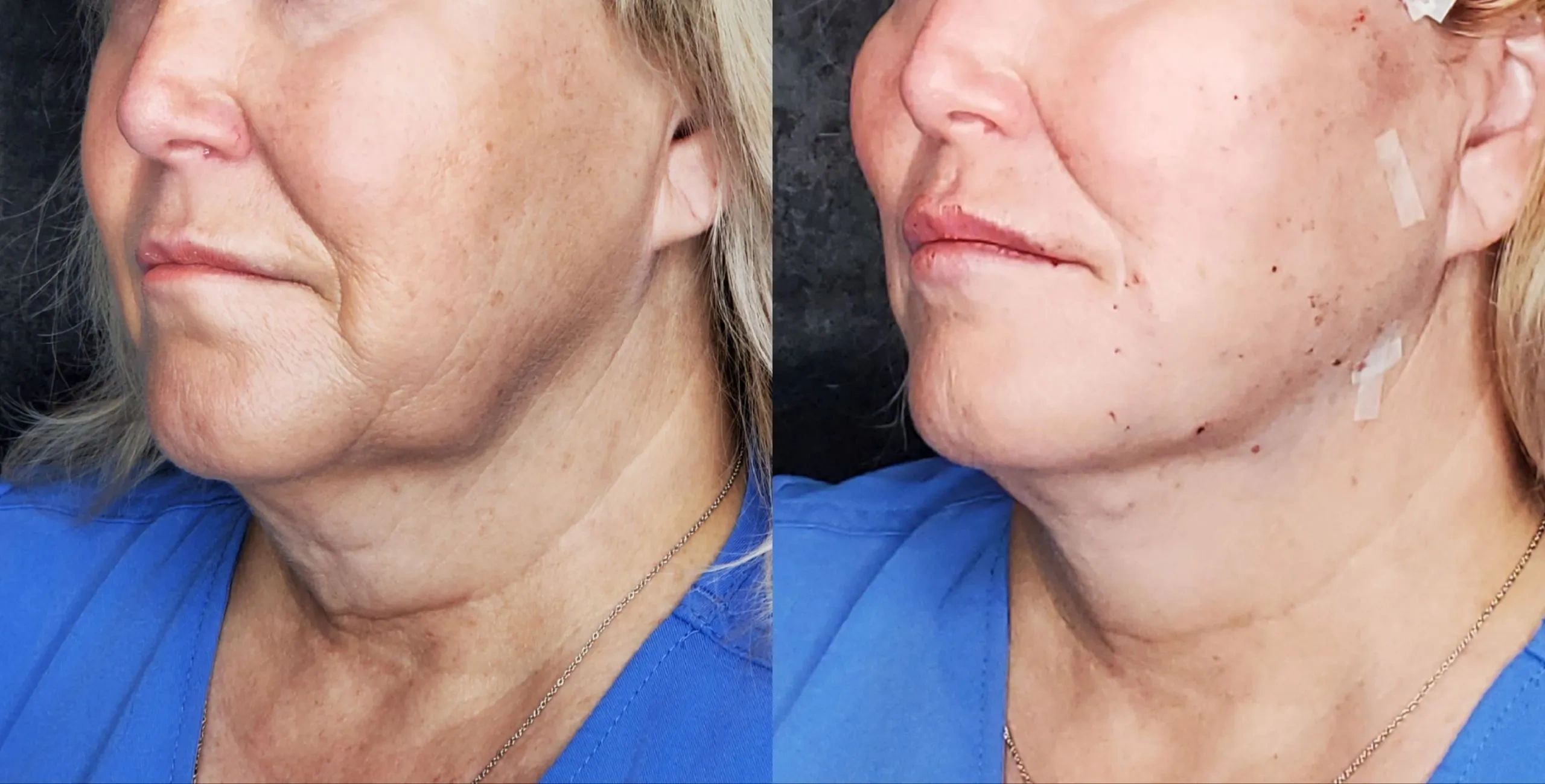 //img1.wsimg.com/isteam/ip/82e99fec-de4b-4203-b2c7-baffd2693fa6/MINT-Threads-Jawline-Nasolabial-Folds-1-scale.webp/:/rs=w:1300,h:800