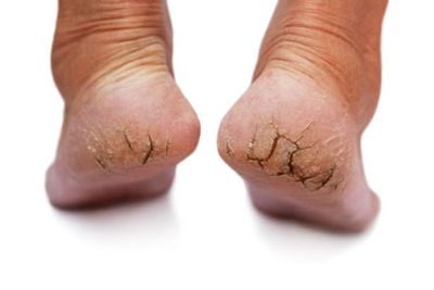 Athlete's Foot (Tinea Pedis) Condition, Treatments and Pictures for Adults  - Skinsight