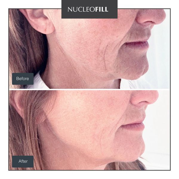 Nucleofill Polynucleotide Training, Skin Booster Certification, Non-Surgical Rejuvenation 