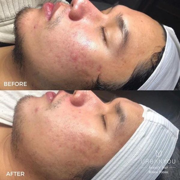 chemical peel training, chemical peel training near me, chemical peel training courses near me