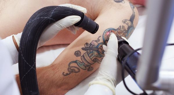 laser tattoo removal training near me, level 5 laser tattoo removal training, laser training, cpd