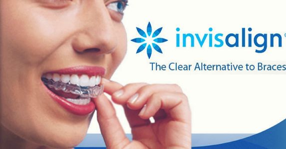 Braces East Sussex, Braces West Sussex, Invisalign West Sussex, Invisalign East Sussex