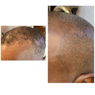 Conceal the visibility of your hair transplant scar with small, color-matched hair follicle deposits