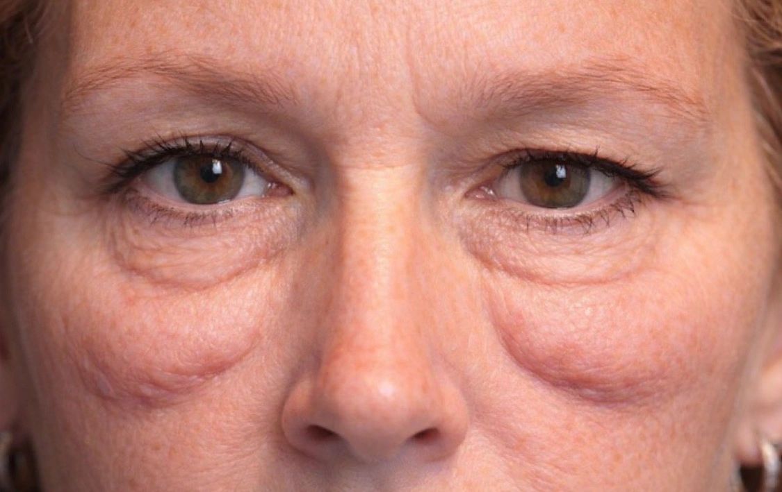 Close-up of the under-eye area showing festoon concerns