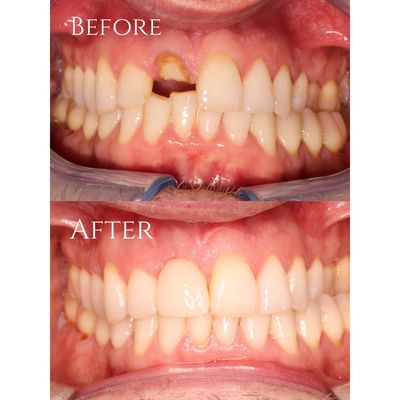 Before and After photo of single tooth dental implant treatment at Hayden Dental, Carmarthen