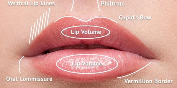Lip areas for filler