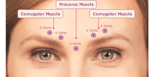 Botox Trifecta