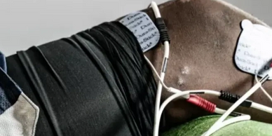 Electrical Stimulation Therapy - Premier Athletic Rehab Center