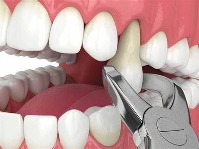 demonstration of tooth being extracted