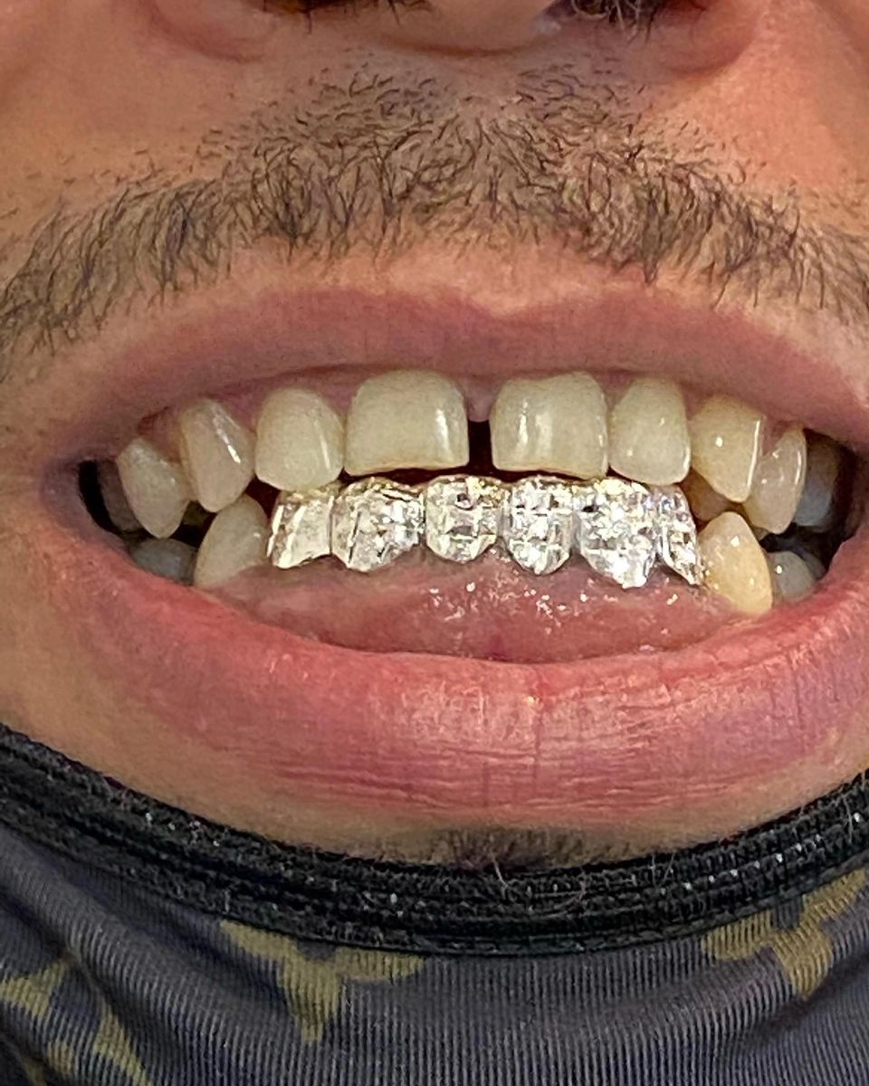 6 Silver Teeth w/ Diamond Cut
