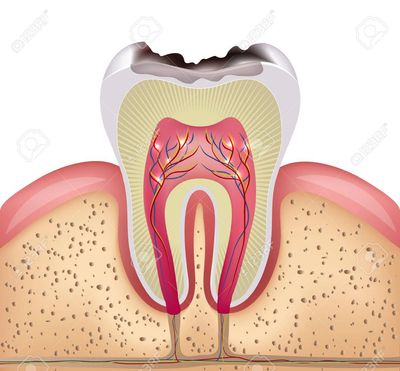 Diş Çürüğü Tedavisi