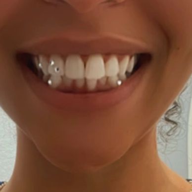Close-up of a smile with unique tooth piercings.
