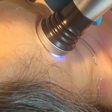 No Needle Mesotherapy (Electroportation)