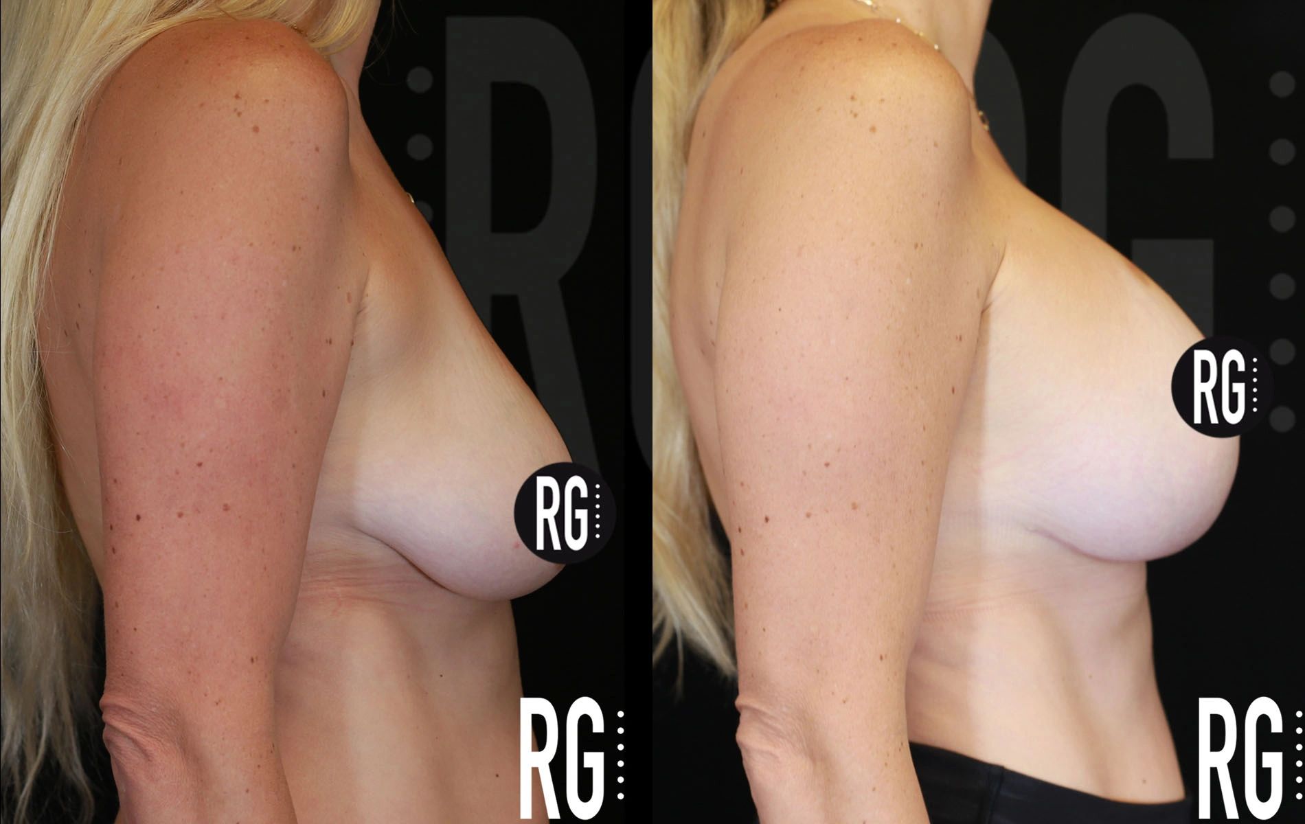 RG- Breast lift- Chest Lipo-s-6mpo copy