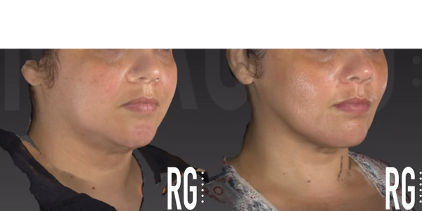 J Plasma Skin Tightening - Facelift Alternative