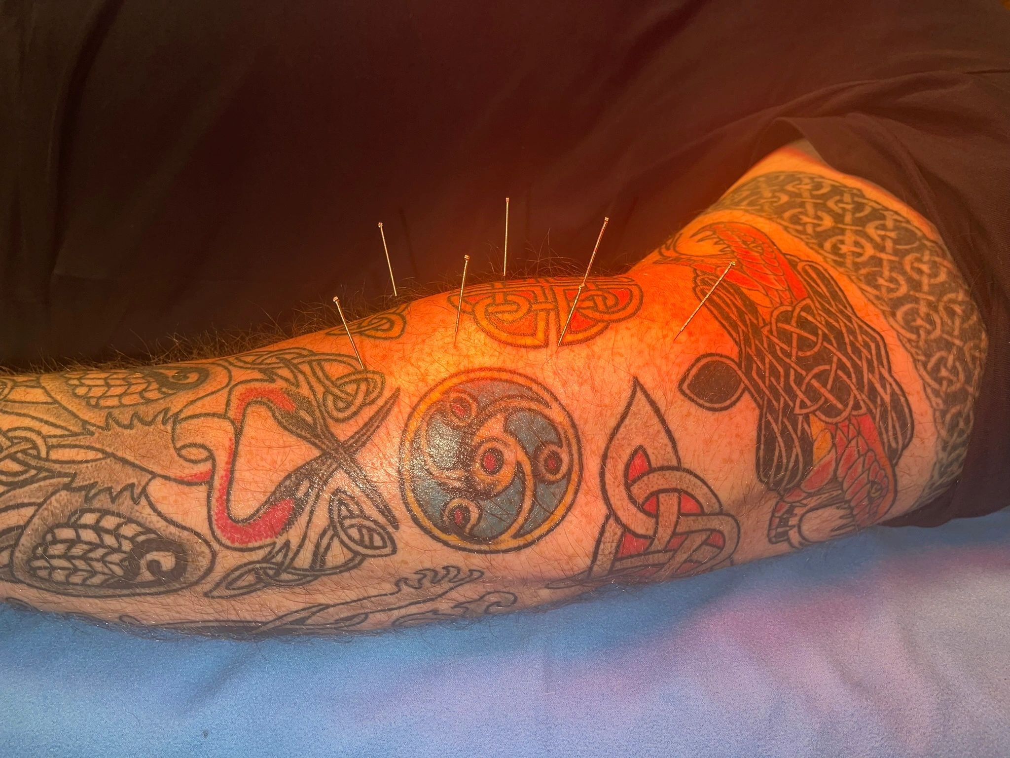 Dry Needling