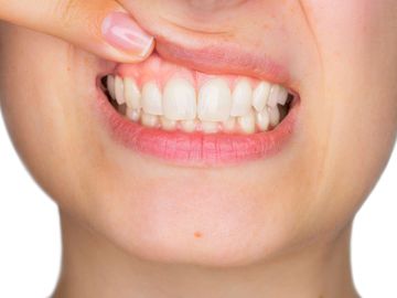 Gum Reshaping | Gum Countouring | Tooth Lengthening | West Hartford Dentist | New Britain CT
