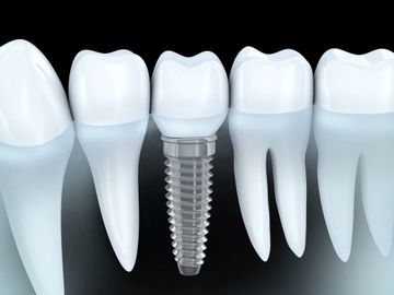 Dental Implants | Implant Dentist West Hartford, CT | New Britain, CT | Dentures on Implants